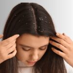 Best Shampoo For Dandruff In India By A Dermatologist